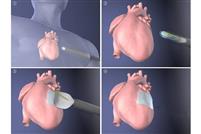 開発した機器を使って心臓表面にシート状の細胞を張り付ける手術のイメージ（升本英利・京大特定助教提供）
