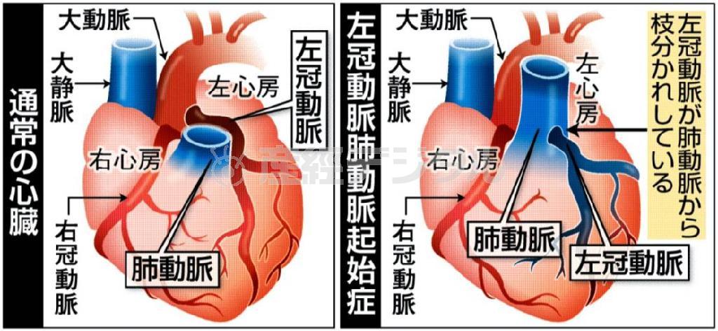 左冠動脈肺動脈起始症