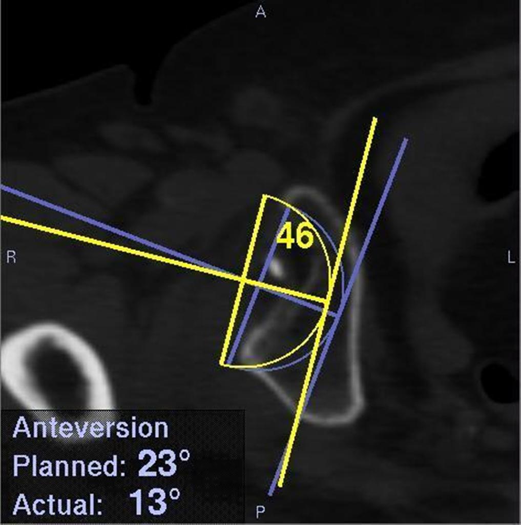 ナビゲーションシステムのモニター画面の一部。実際に人工関節を挿入した角度と位置、当初の計画値も表示されるため、ずれの程度が分かる