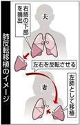肺反転移植のイメージ＝２０１４年５月１４日