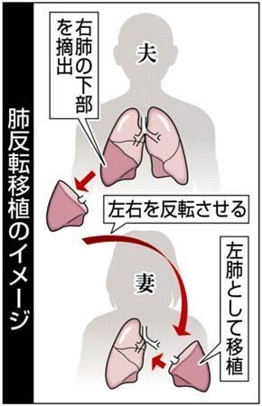 肺反転移植のイメージ＝２０１４年５月１４日