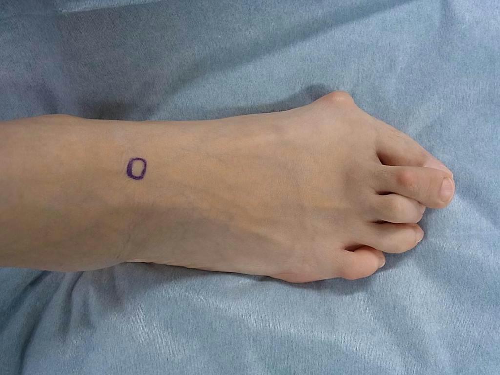 関節リウマチによって変形した足の指（桃原医師提供）