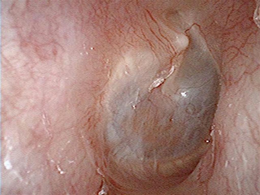 ３カ月後、鼓膜はきれいに再生（金丸真一医師提供）