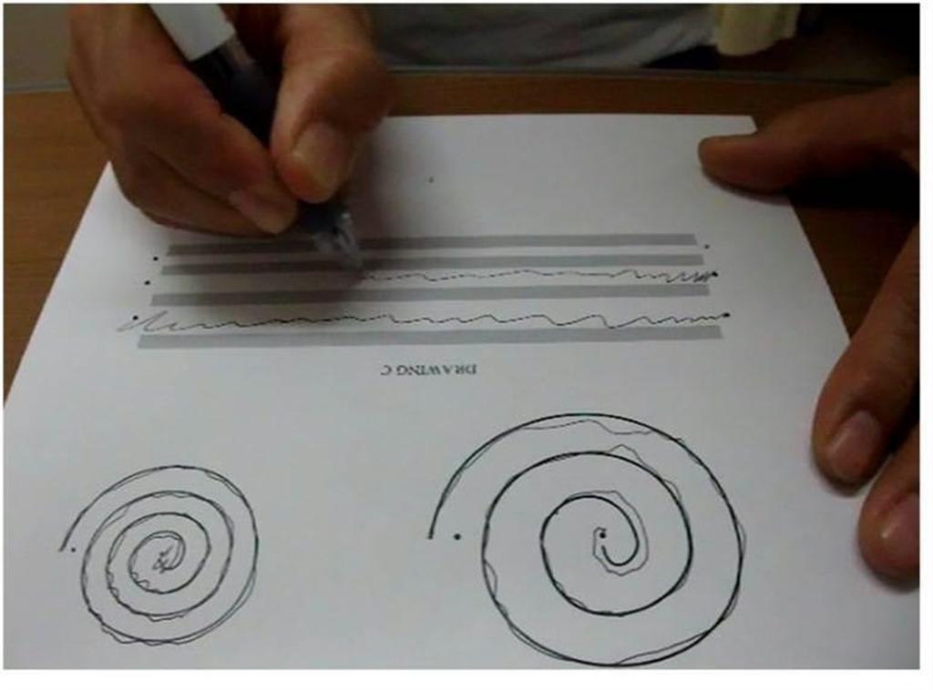 超音波集束装置を使っての治療前、手が震え、渦巻きや平行線に沿ってうまく線が引けない