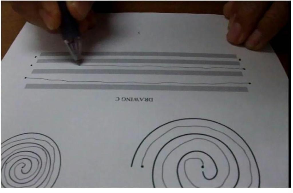 治療後は手の震えも治まり、うまく線が引けるようになった（新百合ケ丘総合病院提供）