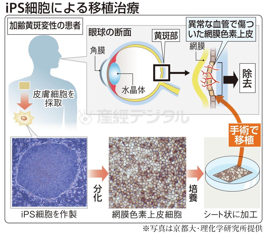 ｉＰＳ細胞（人工多能性幹細胞）による移植治療＝２０１４年９月１２日現在、※写真は京都大・理化学研究所提供