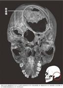 英医学誌に掲載されたリチャード３世（１４５２～８５年）の頭蓋骨の写真。傷は頭部に９つ確認されたが、後頭部に大きく開いた２つの傷が致命傷となった（ＡＰ）