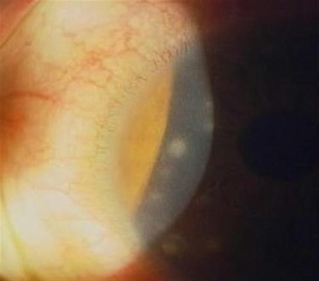 黒目部分に角膜浸潤（写真中央の小円形の白い濁り）がみられる目。２０歳の女性でインターネットでカラコンを購入、眼科医の処方を受けずに使用していた（同）