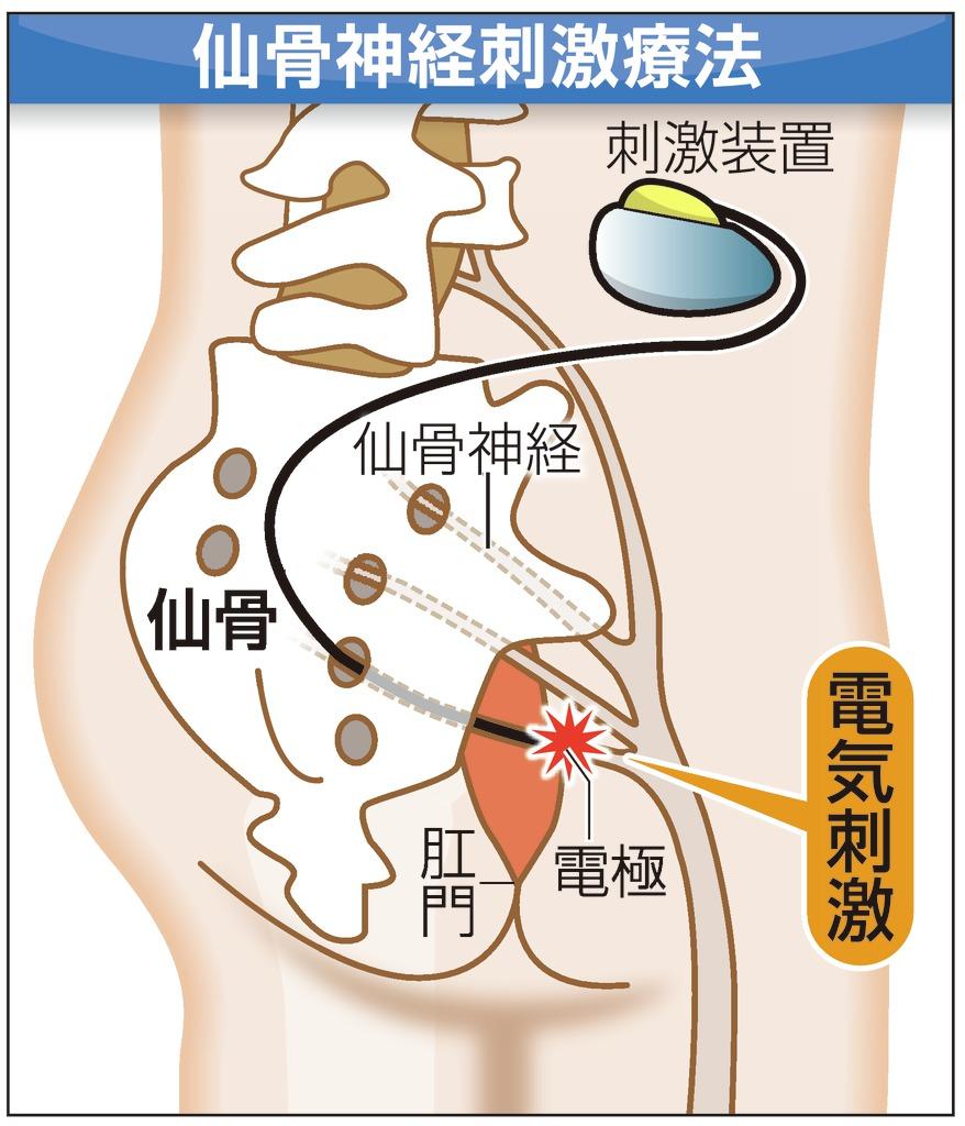 仙骨神経刺激療法