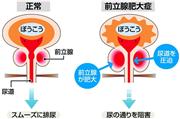 前立腺肥大症