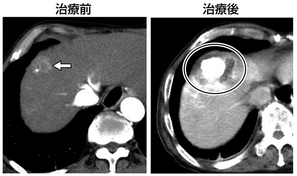 ラジオ波焼灼療法の治療前のＣＴ画像では矢印の部分に病巣が映る。治療後は造影剤で白く映った病巣の周囲まで、十分に壊死したことを示している（工藤正俊教授提供）