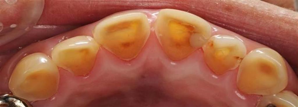 黒酢の原液を飲み続けて、象牙質が露出した状態になった酸蝕歯（東京医科歯科大提供）