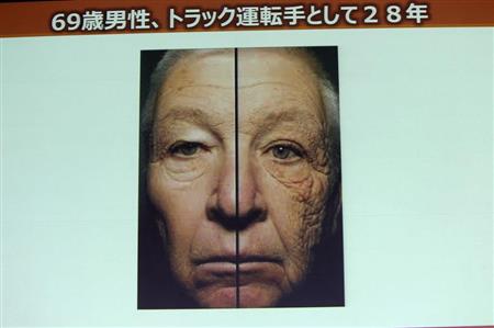 運転席の左側から太陽光を浴びる生活を続けた、６９歳のトラック運転手の写真。肌の変化には外的要因が大きいことを物語っている