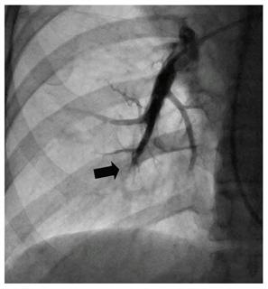 治療前、古い血栓で閉塞した肺動脈の末梢血管（国立循環器病研究センター提供）
