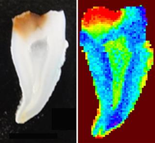 歯の象牙質（左）。左上の暗い部分が虫歯になっている。右は同じ象牙質を特殊な測定法で観察したもの。虫歯の部分にＡＧＥが多く蓄積していることがわかった（大阪大提供）
