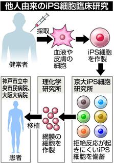他人由来のiPS細胞臨床