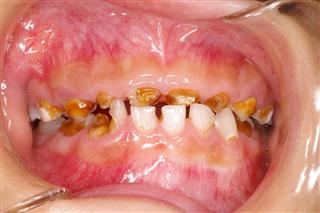 口腔崩壊を起こしている子供の歯（大阪府歯科保険医協会提供）