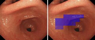 ＡＩが発見した胃がんの内視鏡画像（右）と元の画像。判別しにくいがんを見つけて、紫色に塗り分けた（研究チーム提供）
