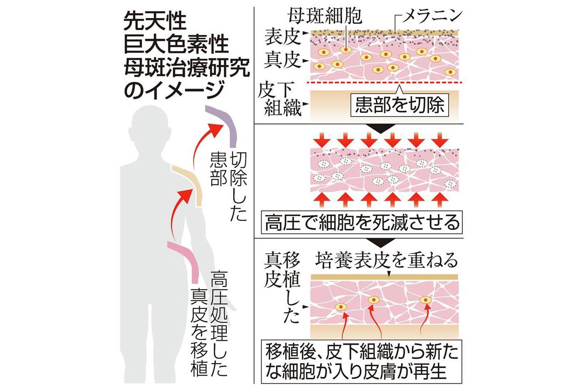 京大 先天性のあざ消しへ治験 皮膚切除し高圧処理した上で移植 Sankeibiz サンケイビズ 自分を磨く経済情報サイト